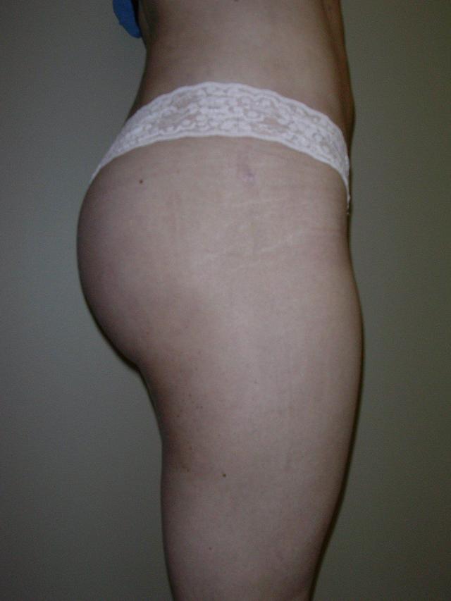 Brazilian Butt Lift after at Plastic Surgery Central Florida in Orlando, FL