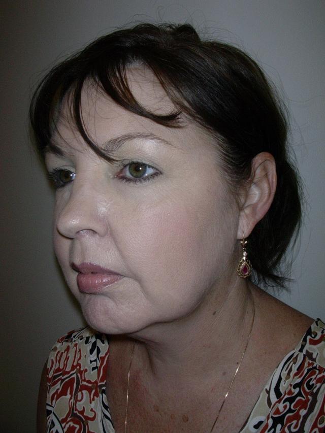 Deep Plane Facelift before at Plastic Surgery Central Florida in Orlando, FL