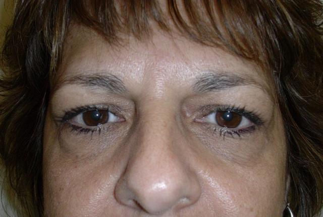 Blepharoplasty before at Plastic Surgery Central Florida in Orlando, FL