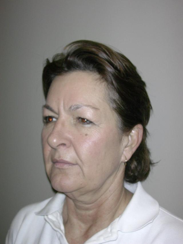 Deep Plane Facelift before at Plastic Surgery Central Florida in Orlando, FL