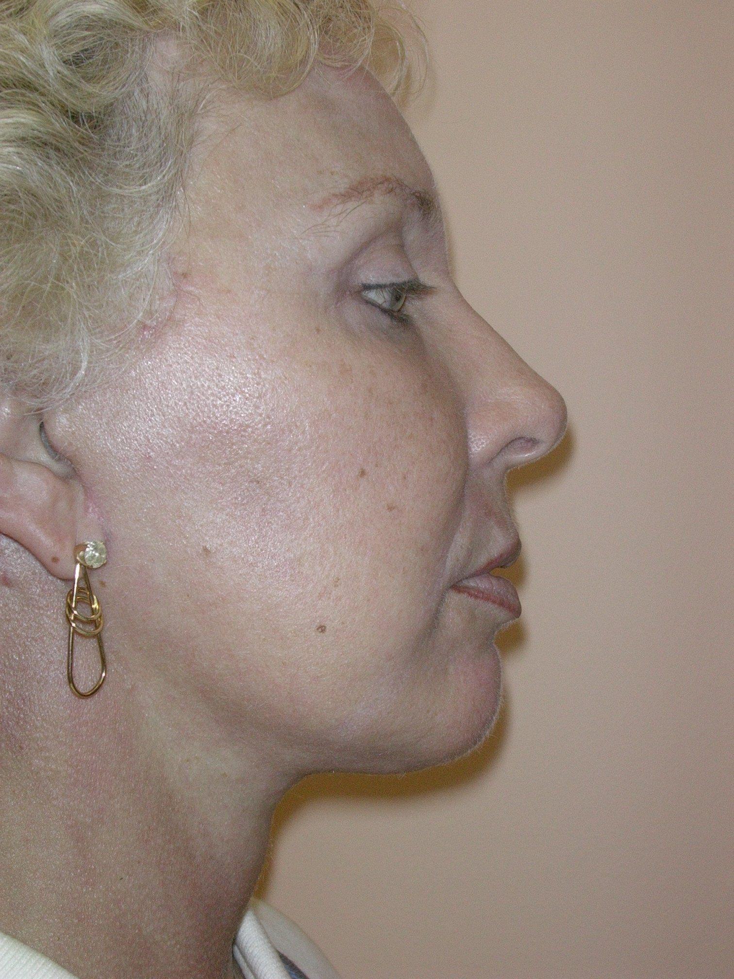 Plastic Surgery Central Florida chin implant after — Orlando, FL