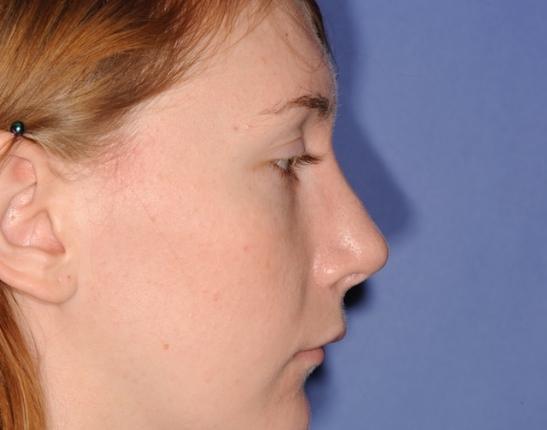 DFW Plastic Surgery | Dr. Yadro Ducic, MD rhinoplasty after — Fort Worth, TX