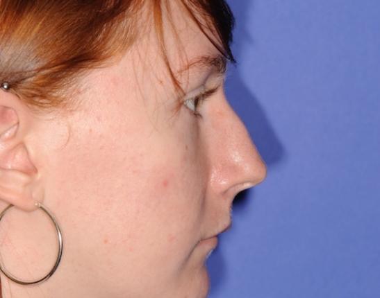 Liquid Rhinoplasty before at DFW Plastic Surgery | Dr. Yadro Ducic, MD in Fort Worth, TX