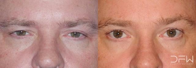 Blepharoplasty result at DFW Plastic Surgery | Dr. Yadro Ducic, MD in Fort Worth, TX