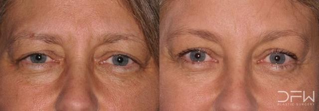 Blepharoplasty result at DFW Plastic Surgery | Dr. Yadro Ducic, MD in Fort Worth, TX