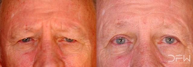 Blepharoplasty result at DFW Plastic Surgery | Dr. Yadro Ducic, MD in Fort Worth, TX