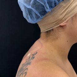 Liposuction after at Med Spa NYC: Beso Aesthetics in New York, NY