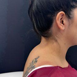 Liposuction before at Med Spa NYC: Beso Aesthetics in New York, NY