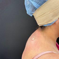 Med Spa NYC: Beso Aesthetics after — New York, NY