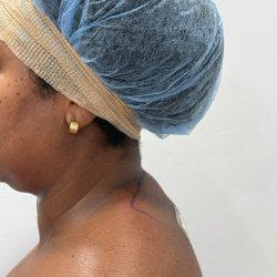 Med Spa NYC: Beso Aesthetics after — New York, NY