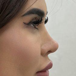 Rhinoplasty after at Med Spa NYC: Beso Aesthetics in New York, NY