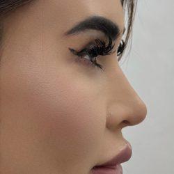Rhinoplasty before at Med Spa NYC: Beso Aesthetics in New York, NY