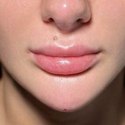 Med Spa NYC: Beso Aesthetics after — New York, NY