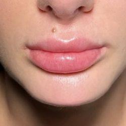Juvederm before at Med Spa NYC: Beso Aesthetics in New York, NY