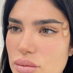 Med Spa NYC: Beso Aesthetics after — New York, NY