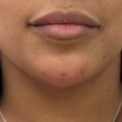 Juvederm after at Med Spa NYC: Beso Aesthetics in New York, NY