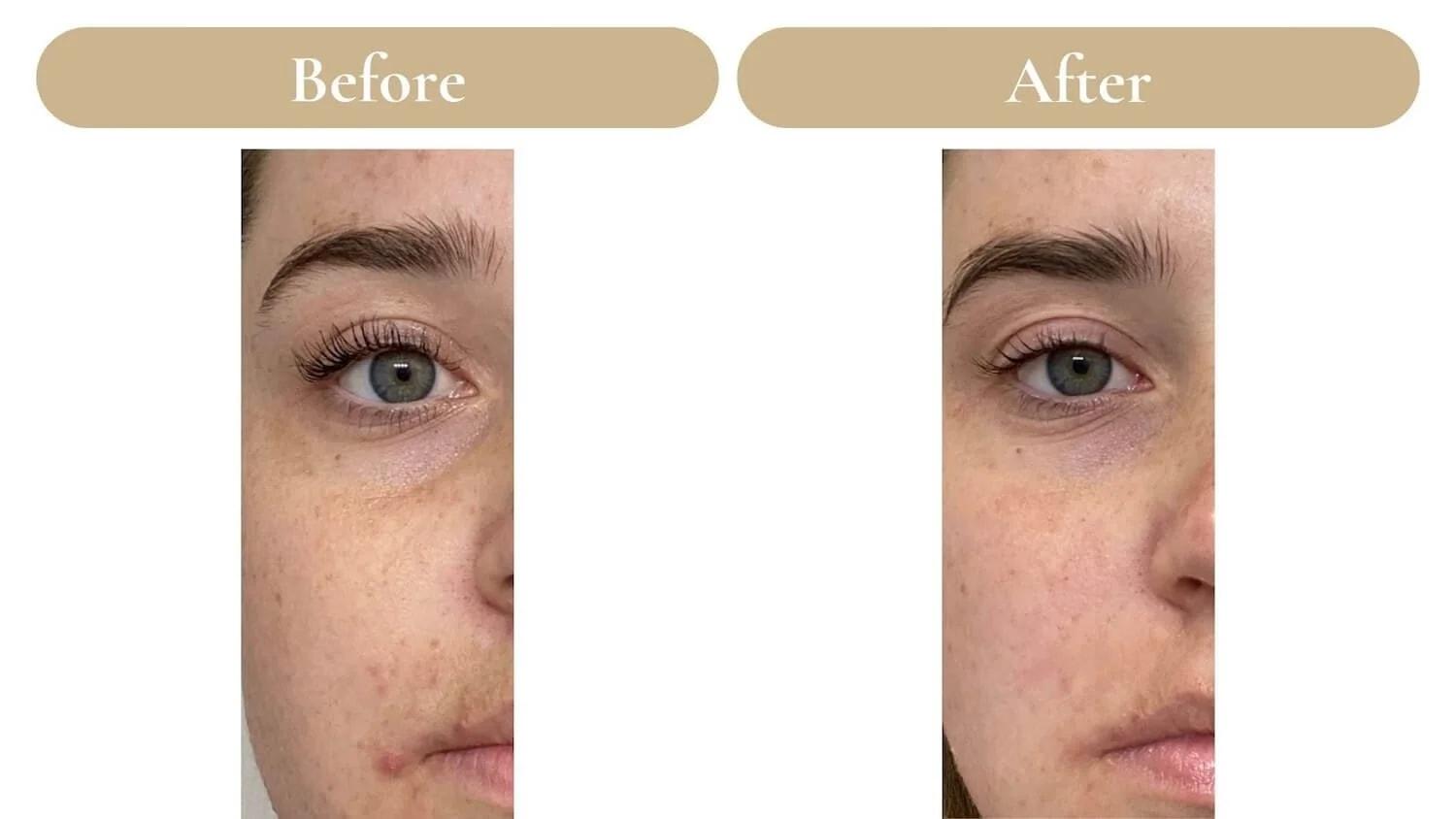 Spa 35 Med Spa chemical peel result — Boise, ID