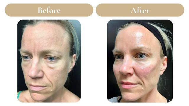 Juvederm result at Spa 35 Med Spa in Boise, ID