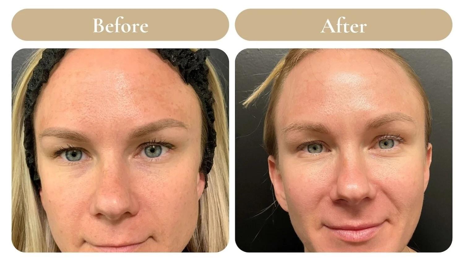 Spa 35 Med Spa chemical peel result — Boise, ID