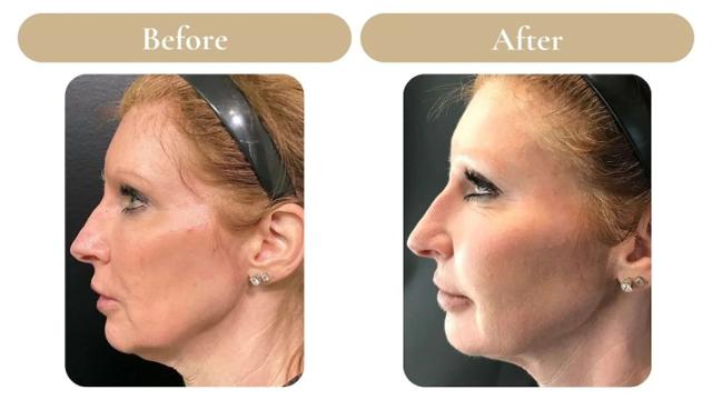 Juvederm result at Spa 35 Med Spa in Boise, ID
