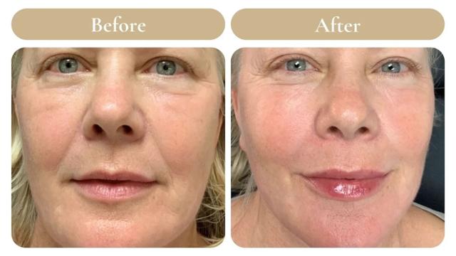Lip Filler result at Spa 35 Med Spa in Boise, ID