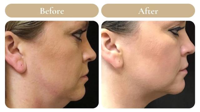 Kybella result at Spa 35 Med Spa in Boise, ID