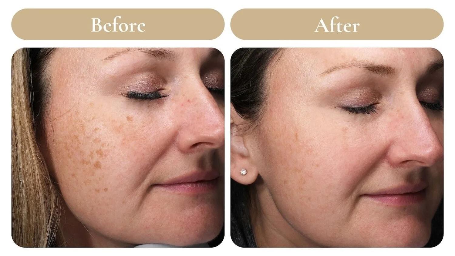 Spa 35 Med Spa photofacial result — Boise, ID
