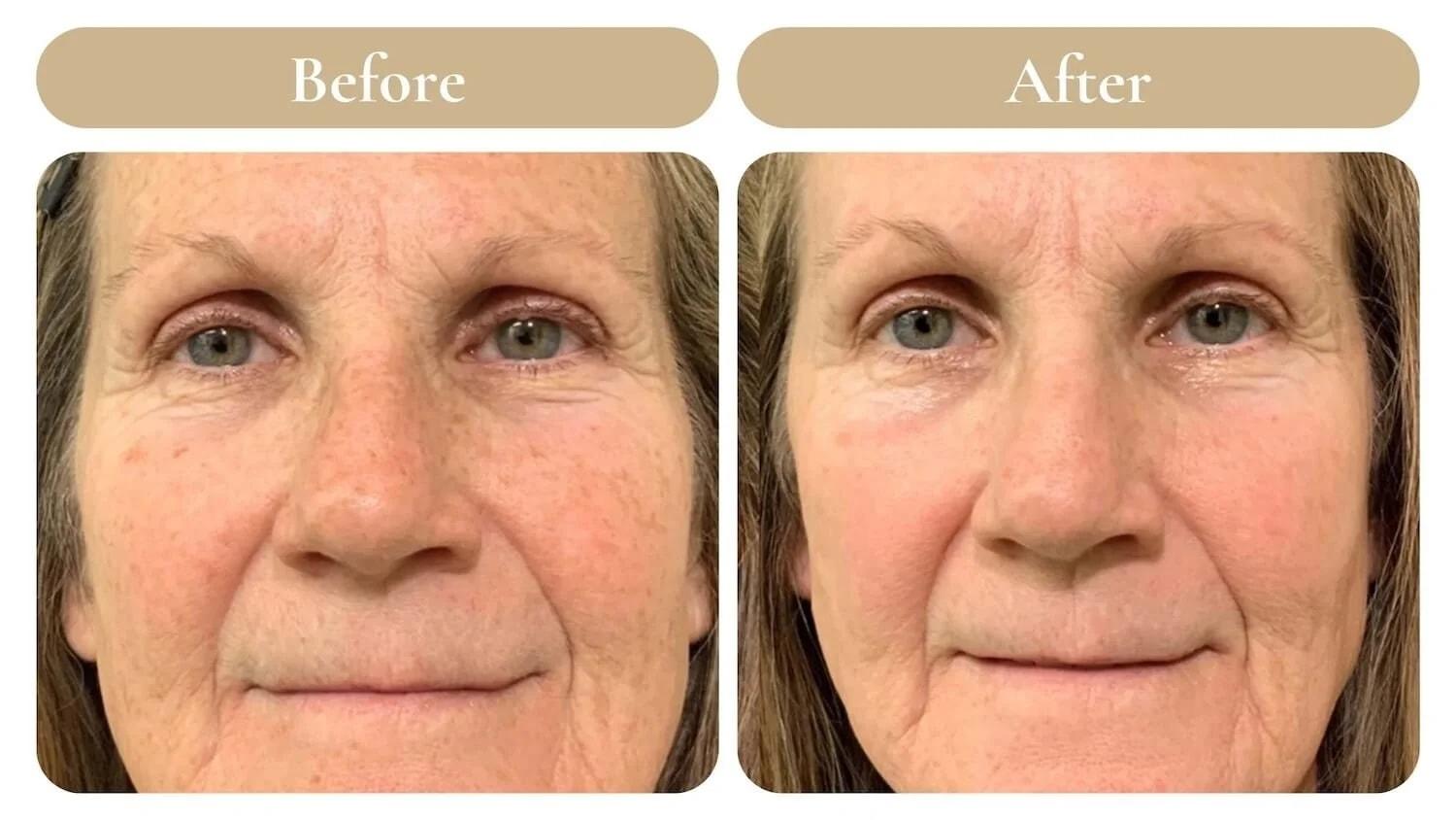 Spa 35 Med Spa chemical peel result — Boise, ID