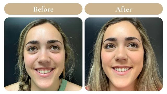 Botox result at Spa 35 Med Spa in Boise, ID