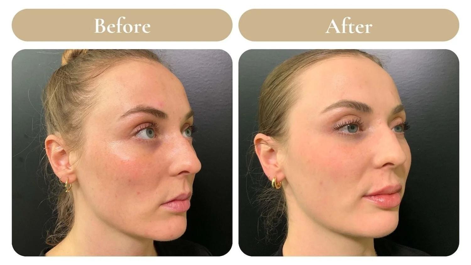 Spa 35 Med Spa laser treatment result — Boise, ID