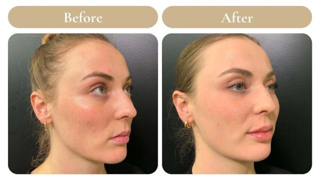 Laser Skin Resurfacing result at Spa 35 Med Spa in Boise, ID