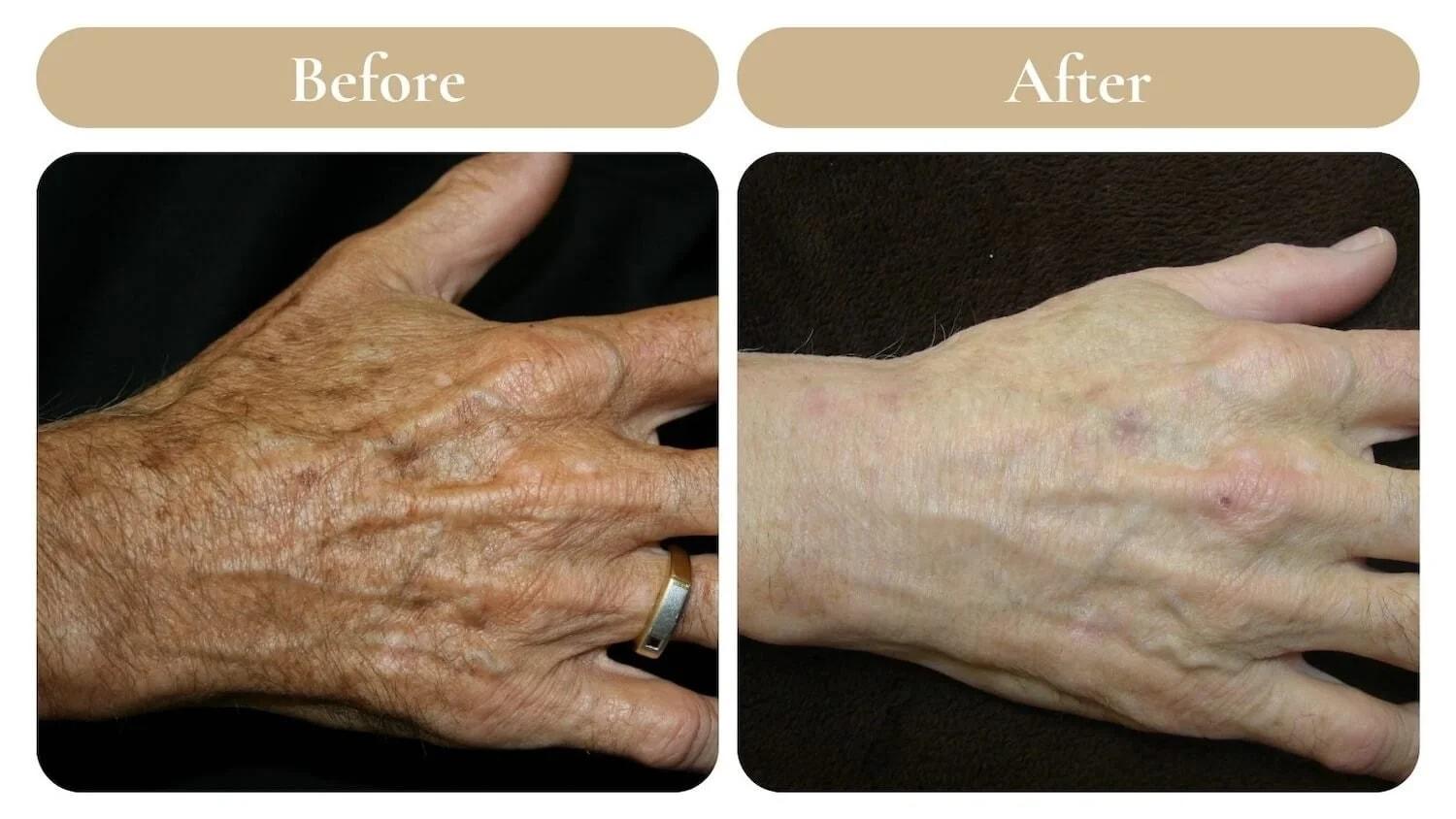 Spa 35 Med Spa photofacial result — Boise, ID