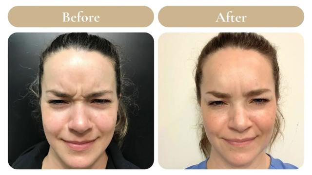 Botox result at Spa 35 Med Spa in Boise, ID