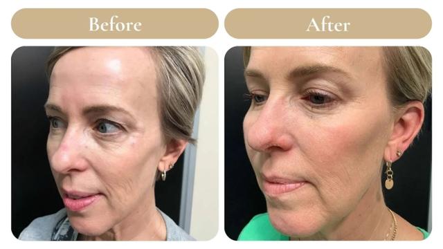 Juvederm result at Spa 35 Med Spa in Boise, ID