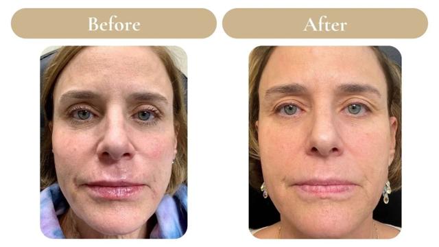 Juvederm result at Spa 35 Med Spa in Boise, ID