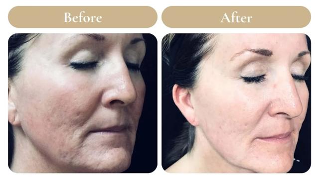 Laser Skin Resurfacing result at Spa 35 Med Spa in Boise, ID