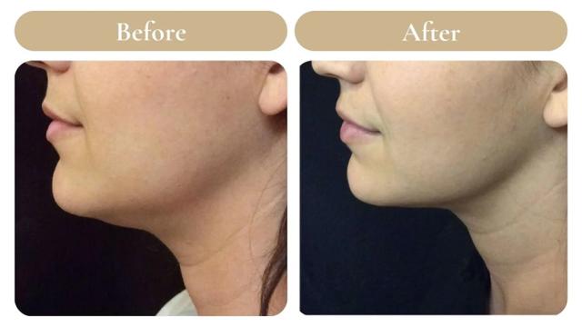 Kybella result at Spa 35 Med Spa in Boise, ID