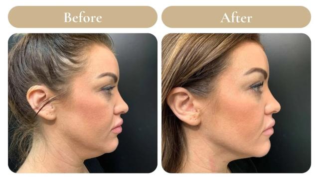 Kybella result at Spa 35 Med Spa in Boise, ID