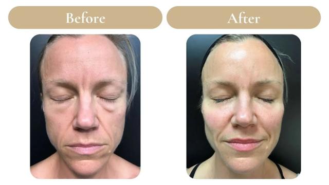Juvederm result at Spa 35 Med Spa in Boise, ID