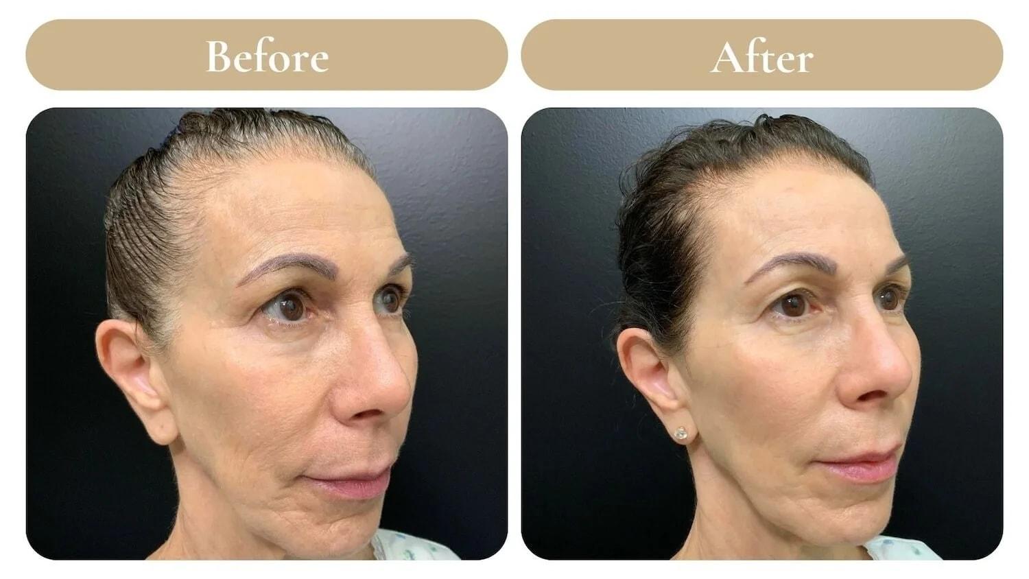 Spa 35 Med Spa laser treatment result — Boise, ID