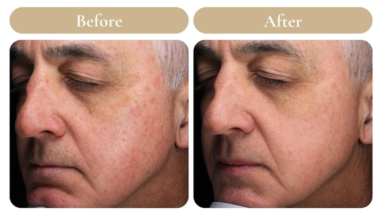 Spa 35 Med Spa photofacial result — Boise, ID