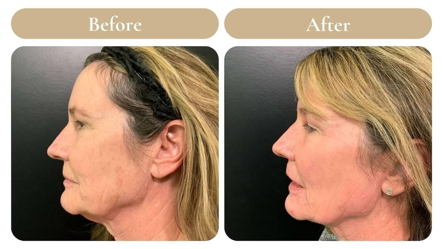 Spa 35 Med Spa laser treatment result — Boise, ID