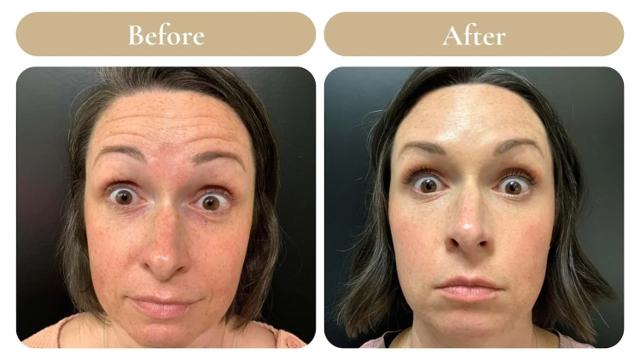 Botox result at Spa 35 Med Spa in Boise, ID