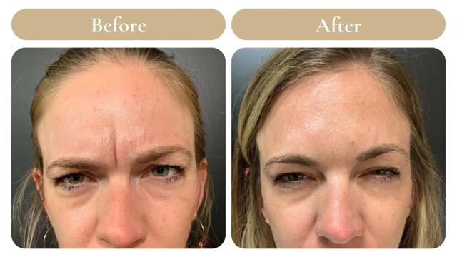 Botox result at Spa 35 Med Spa in Boise, ID
