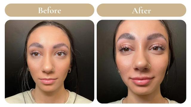 Lip Filler result at Spa 35 Med Spa in Boise, ID
