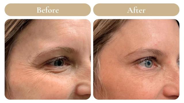 Botox result at Spa 35 Med Spa in Boise, ID