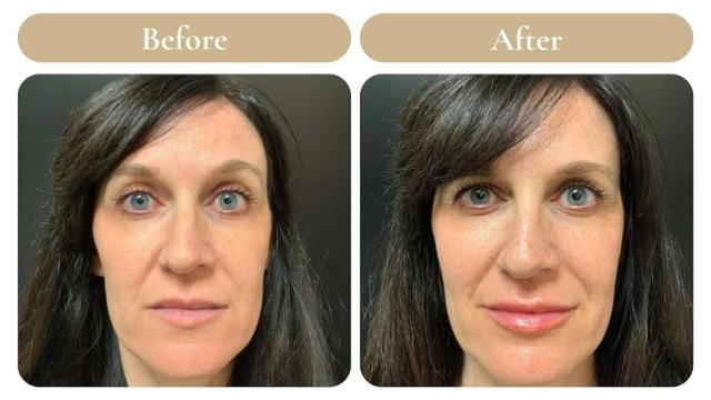 Juvederm result at Spa 35 Med Spa in Boise, ID