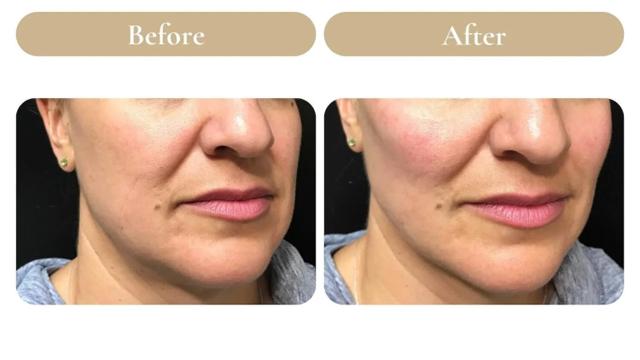 Juvederm result at Spa 35 Med Spa in Boise, ID