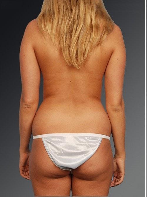Liposuction before at Steven Teitelbaum, MD in Santa Monica, CA