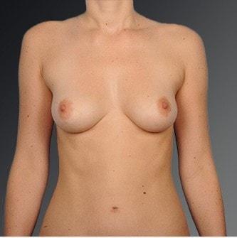 Fat Transfer Breast Augmentation before at Steven Teitelbaum, MD in Santa Monica, CA